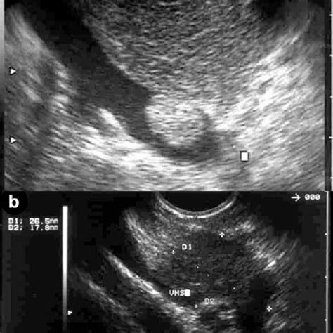 A Linear Array Endoscopic Ultrasound Image Of A Pancreatic Carcinoma