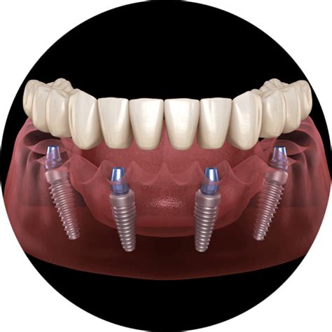 Full Mouth Dental Implants Laguna Hills California