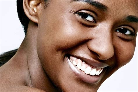 Melasma Pigmentation For Dark Skin Types