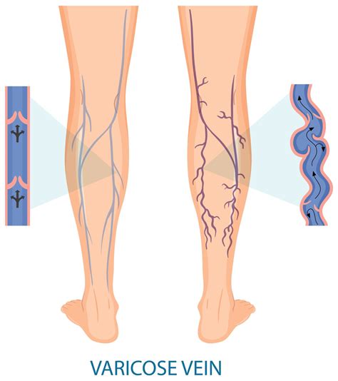 Empower Yourself Effective Strategies For Self Managing Varicose Veins