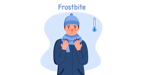 Frostbite Symptoms Causes And First Aid Guide