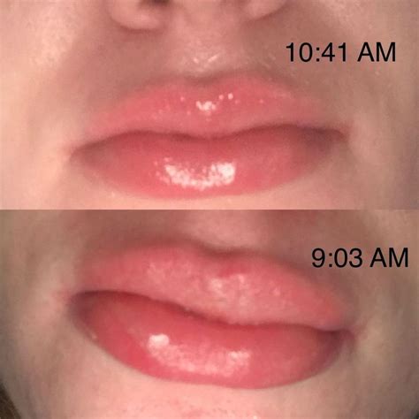 Allergic Reaction Bumps On Lips