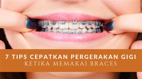 Hi guys~ so vlog kalini aku dah buka braces setelah setahun pakai. Nad's Braces Journey - 7 Tips Cepatkan Pergerakan Gigi ...