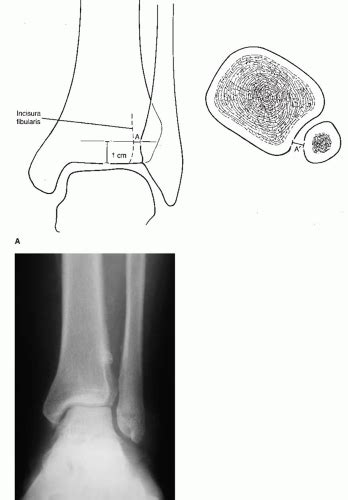 Ankle Fracture Malunion And Late Syndesmosis Reconstruction
