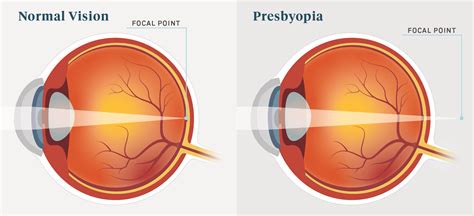 Presbyopia Causes Symptoms And Treatment