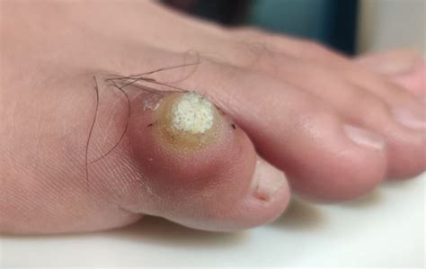 Corn Vs Wart On Foot How To Tell The Difference And Get Treatment