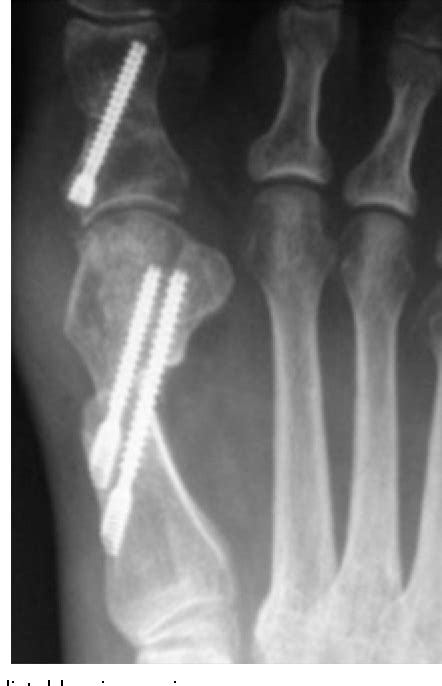 Figure 1 From Minimally Invasive Osteotomies Semantic Scholar