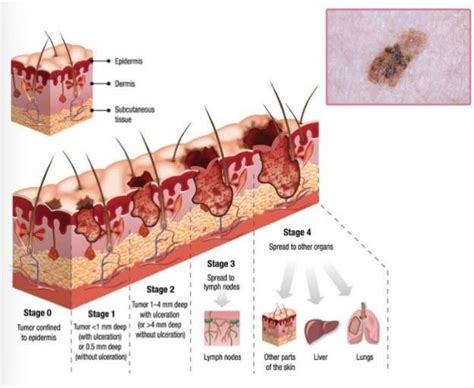 Stage 4 Stage 1 Melanoma Skin Cancer Cancerwalls