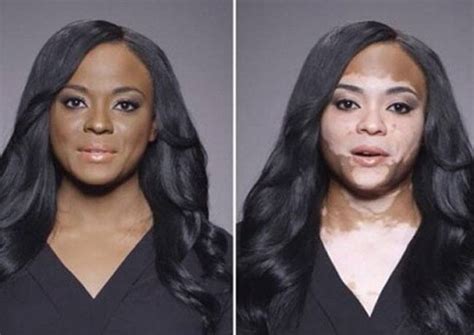Vitiligo Tips And Advice On How To Remedy Them At Home