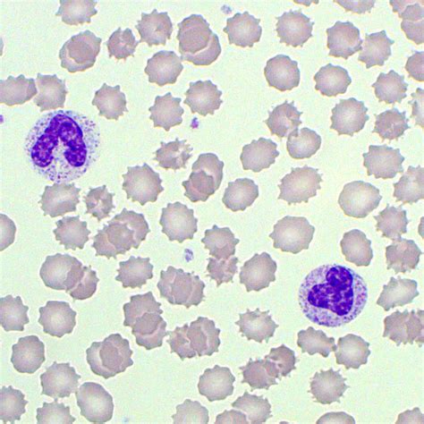 Poikilocytosis Blood Film Medschool