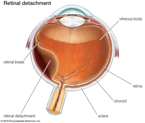 Detached Retina Causes Symptoms And Treatment Britannica