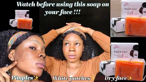 Side Effects Of Kojie San Soap No One Is Telling You Youtube