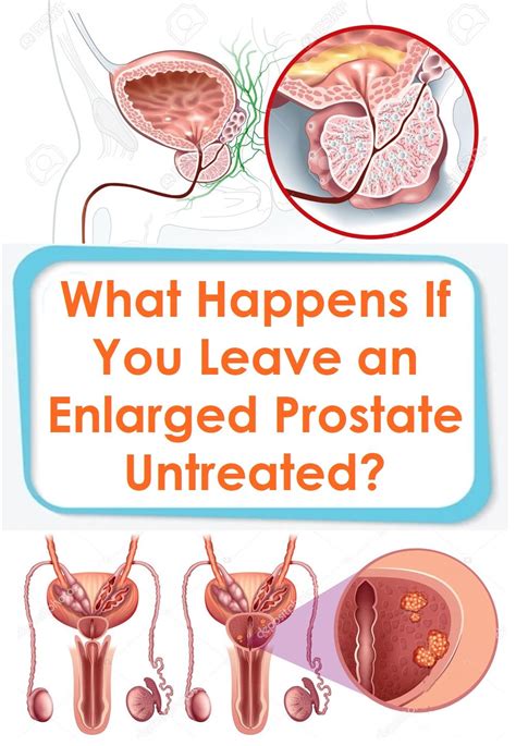 What Happens If You Leave An Enlarged Prostate Untreated In 2021