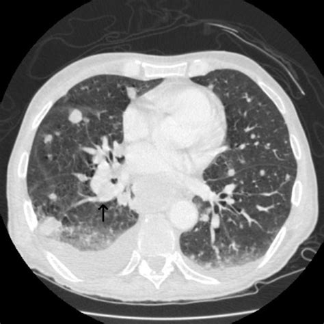 Right Hilar Mass Noted With Multiple Pulmonary Nodules Scattered