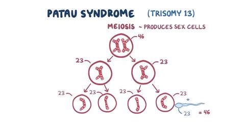 Patau Syndrome Trisomy 13 Video And Anatomy Osmosis