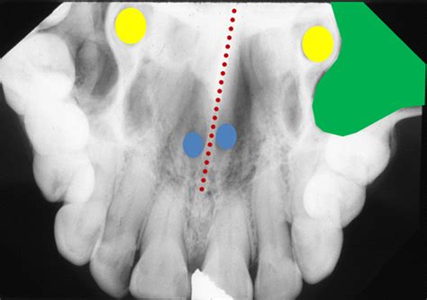 Anatomy On Radiographs Occlusal Radiographs Dr Gs Toothpix
