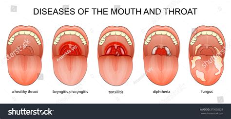 Illustration Of The Inflammatory Diseases Of The Throat 373055323
