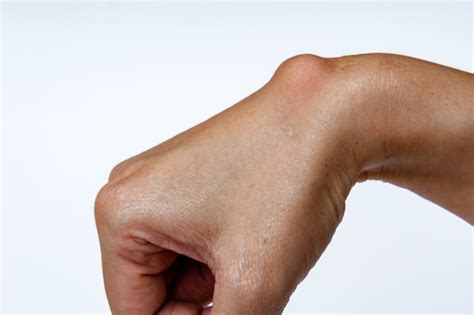 The Symptoms Treatment And More Information About Ganglion Cysts