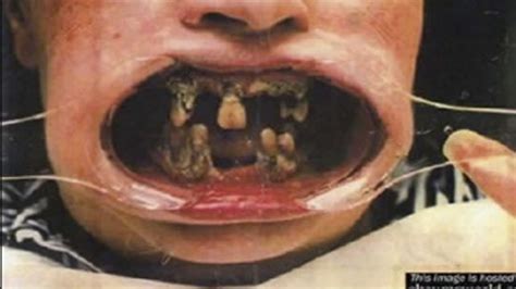 Disgusting People Who Need To See A Dentist Immediately Their Teeth Will Make You Cringe