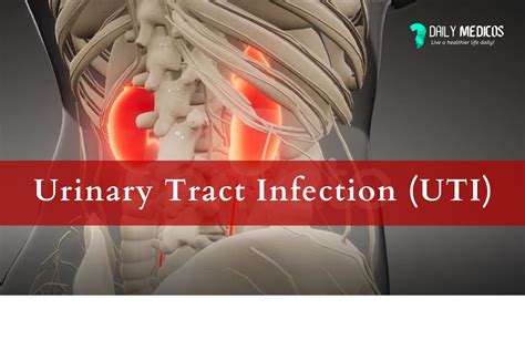 Urinary Tract Infection Uti Types Of Uti Risk Factors And Treatment Daily Medicos