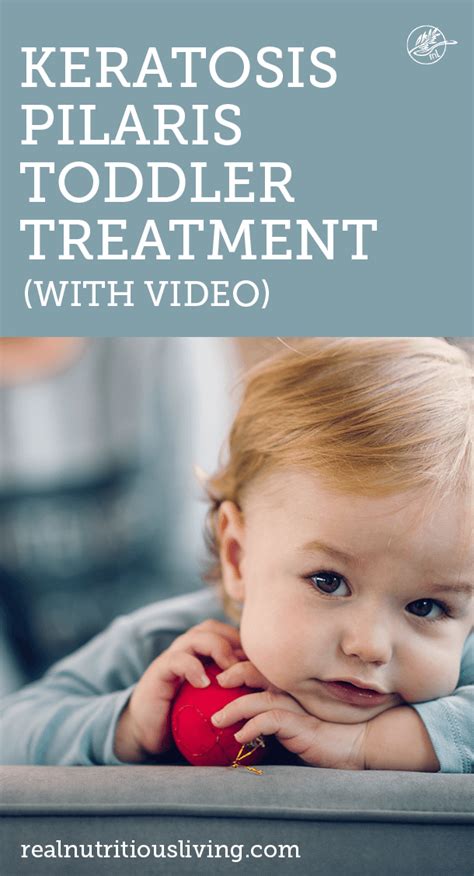 Keratosis Pilaris Toddler Treatment With Video Real Nutritious Living