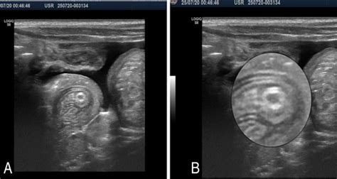 A Case Of Ultrasound Diagnosis Of Intestinal Ascariasis Clinically