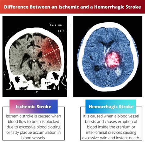 Ischemic Vs Hemorrhagic Stroke Difference And Comparison