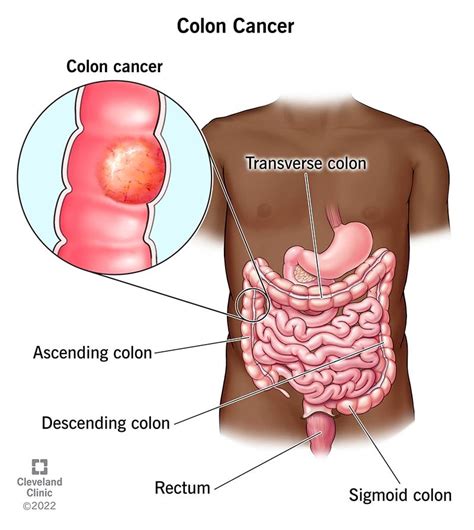 Cancer Colon Transverse Symptoms Hpv Subtypes Genital Warts My Xxx