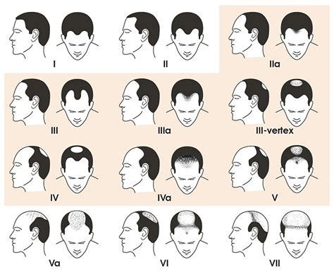 Where Are You On The Norwood Hair Loss Scale Vinci Hair Clinic
