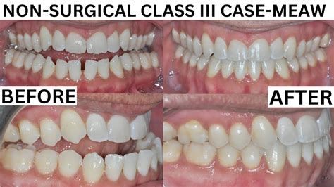 Severe Underbite Correction Using The Meaw Technique No Surgery Adult