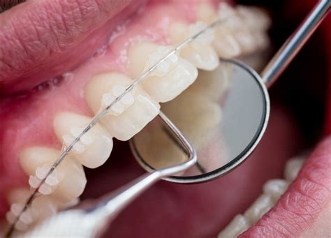 Ortodoncia — Clinicadentaltobalaba