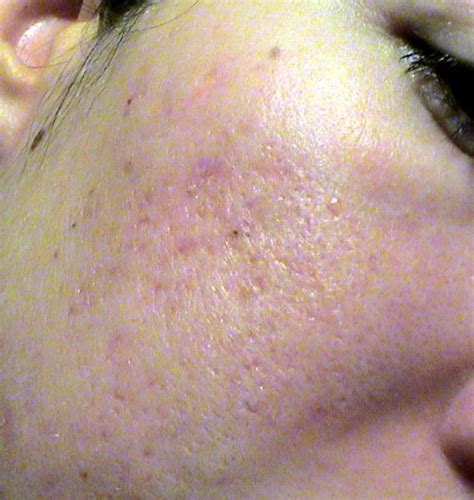 Scar Logs Acne Scars After First Tca Cross Right Image 4 Pictures