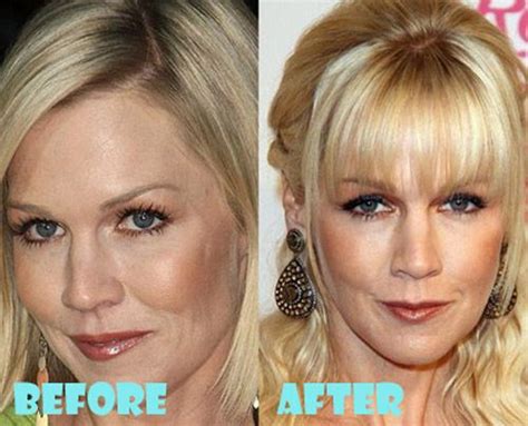 Jennie Garth Plastic Surgery Before And After Plastic Surgery Botox