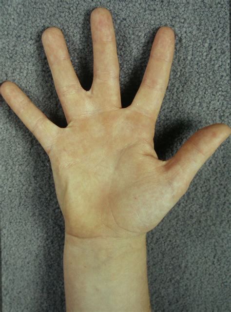 Partial Syndactyly Congenital Hand And Arm Differences