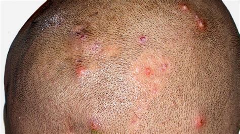 Scalp Folliculitis Signs Causes Treatment And More