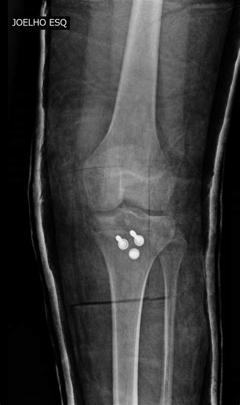 Avulsion Fracture Of The Anterior Tibial Apophysis Image