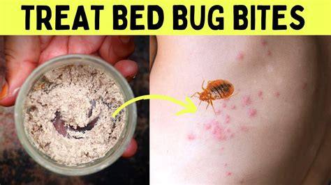 How To Get Rid Of Bed Bug Bites Overnight Fast In One Day At Home On
