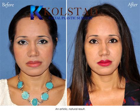 Dr Kolstad San Diego Facial Plastic Surgeon