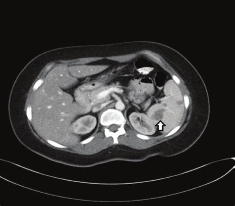 A Ct Scan Of Abdomen Shows Multiple Hypodense Lesions In The Spleen
