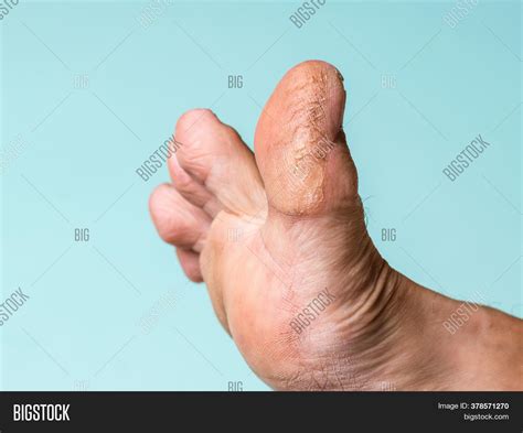 Big Toe Left Foot Man Image And Photo Free Trial Bigstock