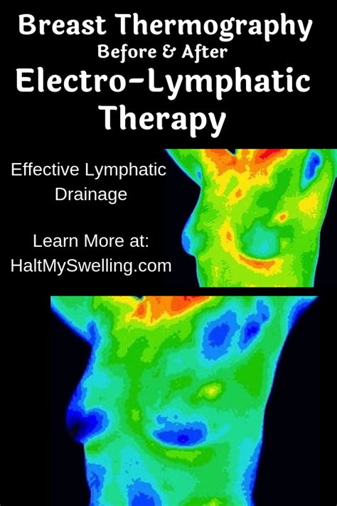Electro Lymphatic Therapy Is The Most Effective Method Of Lymph