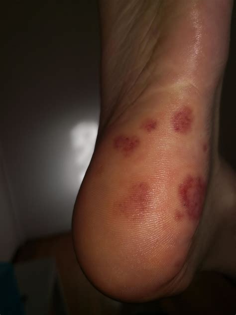 Update Its Not Ringworm Or A Fungal Infection Like Everyone Has Been