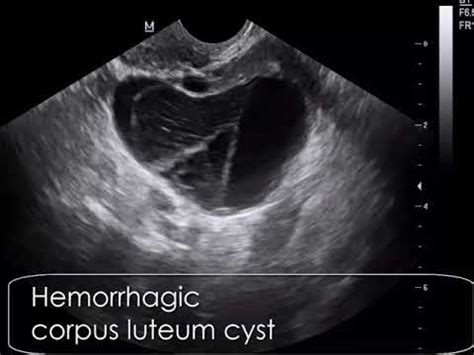 Case Hemorrhagic Corpus Luteum Cyst CLC YouTube