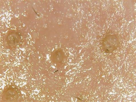Acne Clogged Pores Oily Combination Skin Under A Microscope