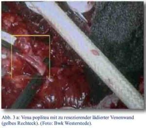 A severe bacterial infection or lack of blood flow can cause body tissue to die. BEHANDLUNGSVERLAUF EINER SUBTOTALEN OBERSCHENKELAMPUTATION ...