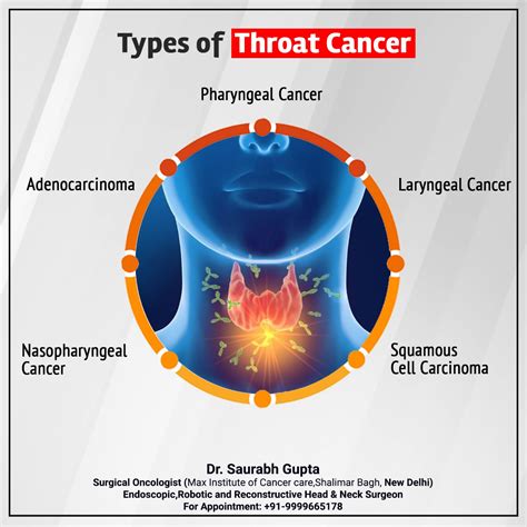 Dr Saurabh Gupta Oncologist Types Of Throat Cancer