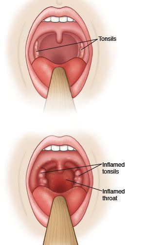 Acute Viral Pharyngitis Sore Throat
