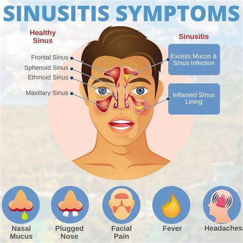 👃 Didyouknow Nearly 35 Million Americans Have Sinusitis Inflamed Or