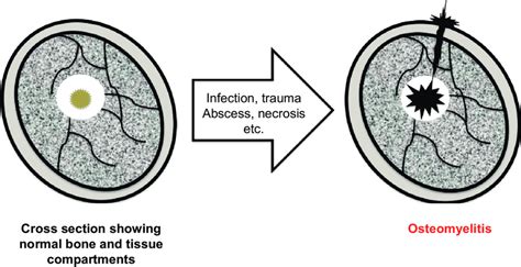 Pathophysiology Of Osteomyelitis Characterized By Spread Of Infection