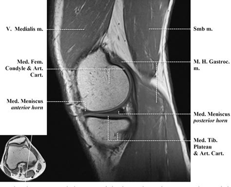 The muscles that affect the knee's movement run along the thigh and calf. Knee Muscle Anatomy Mri : Atlas Of Knee Mri Anatomy W ...